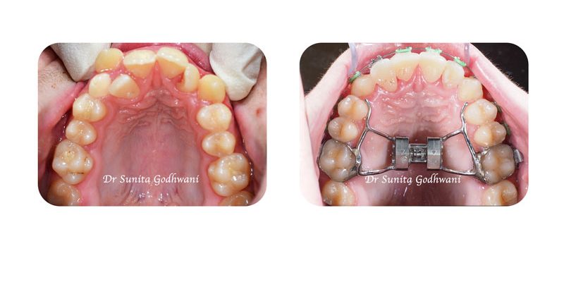 5.-Slider-for-Rapid-macillary-expansion