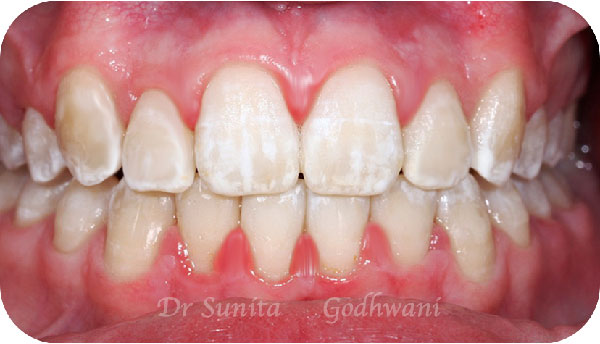 After image