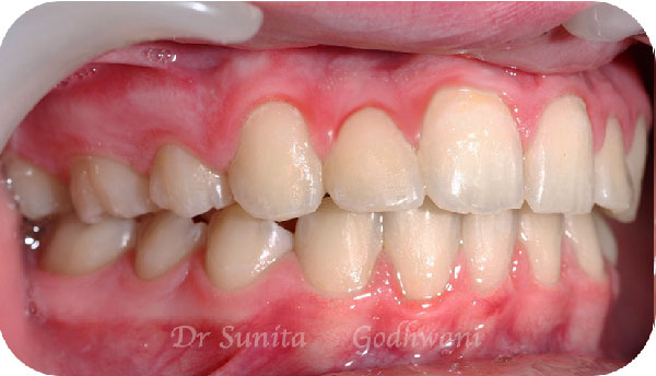 After image