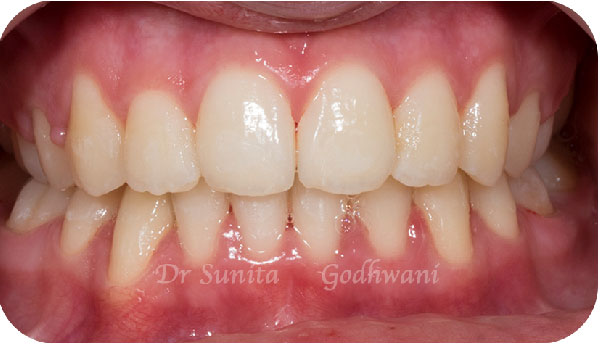 After image