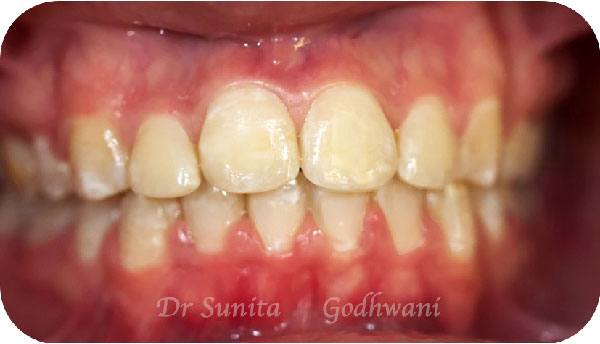 After image