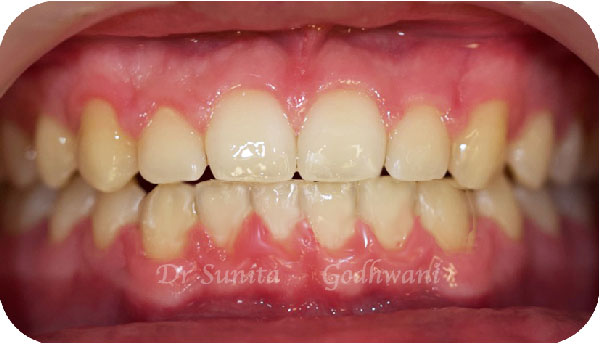 After image